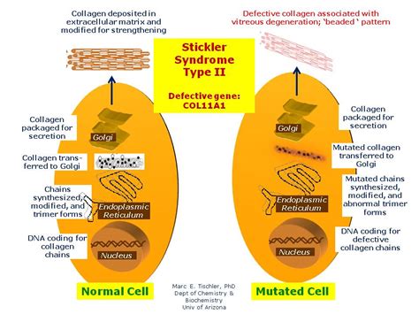 Stickler Syndrome, Type II | Hereditary Ocular Diseases