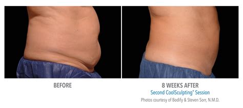 CoolSculpting Abdomen / Stomach Before and After Photos NYC