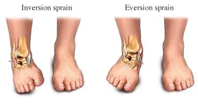 Inversion Ankle Sprains | Chiropractor Vancouver