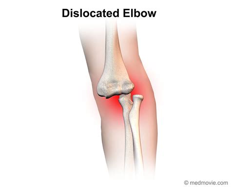 Elbow Dislocation – Medmovie.com