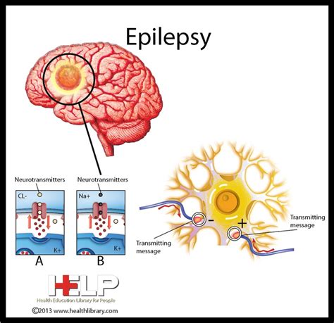 Epilepsy | Nervous System | Pinterest