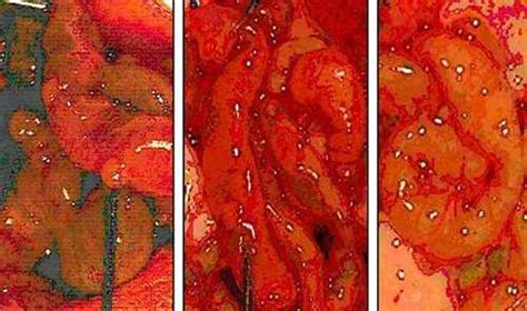 Primary Peritoneal Cancer - Prognosis, Survival Rate, Life Expectancy ...