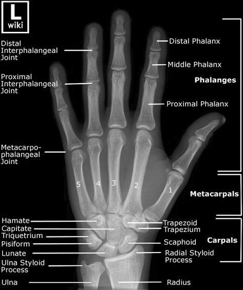 Radiographic Anatomy of the Hand. Clínica de Artrosis y Osteoporosis www.clinicaartrosis.com; es ...