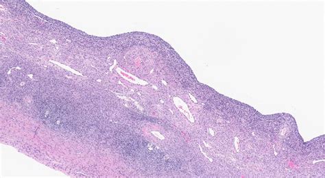 Follicular Cyst Histology