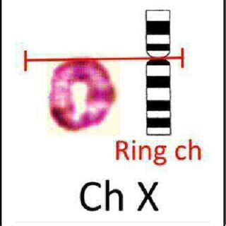 Chromosomal abnormality observed as a ring chromosome in X chromosome. | Download Scientific Diagram