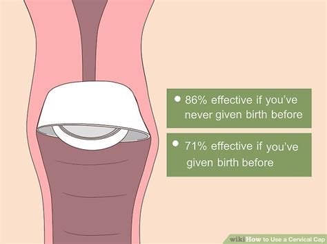 How to Use a Cervical Cap - wikiHow