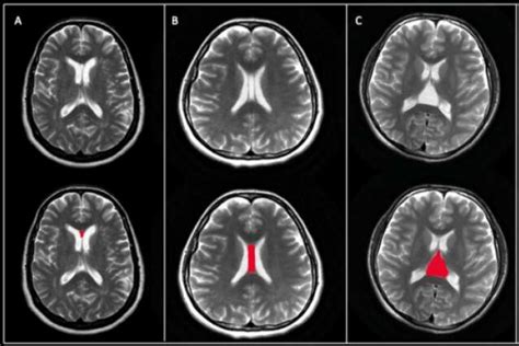 Septum Pellucidum Mri