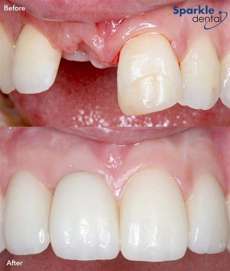 Dental Implants Options | Sparkle Dental