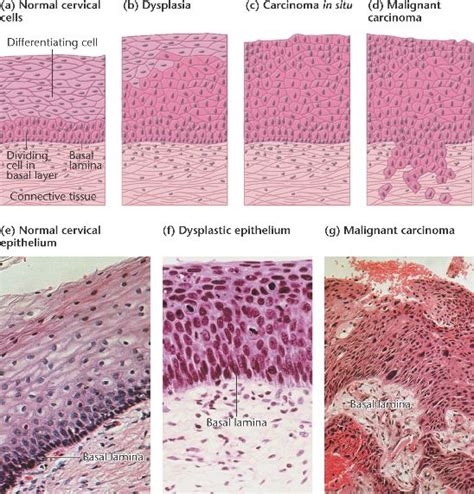 cervical_cancer.html 18_03-cervical_cancer.jpg