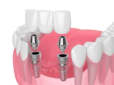 Turkish Teeth Implants: Procedure and Cost - Dentatur