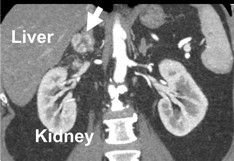 Overview of Adrenal metastasis