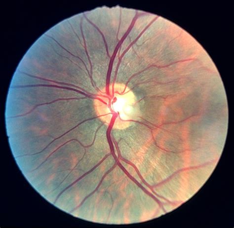Optic disc pit 3 - Retina Image Bank