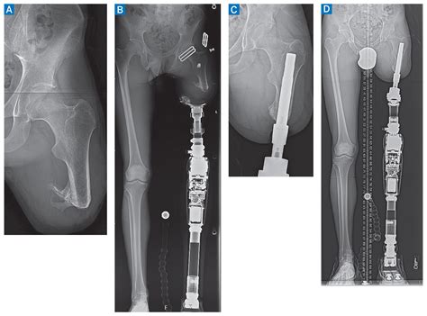 Transfemoral Osseointegration After Amputation | HSS Case