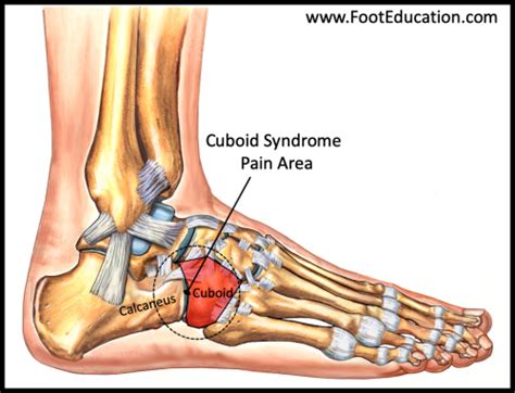 Sindrome cuboide | El Festival