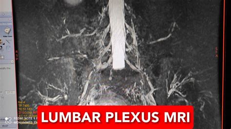 Lumbar Plexus Mri Protocol