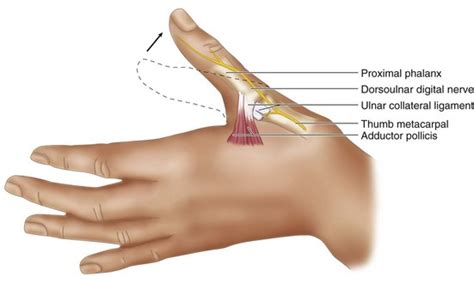 58: Skier’s Thumb: Repair of Acute Thumb Metacarpophalangeal Joint Ulnar Collateral Ligament ...