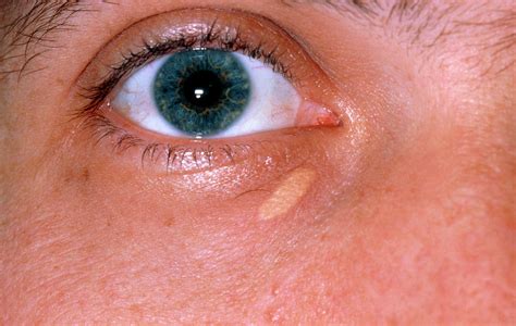 Xanthelasma Deposit On Lower Eyelid Photograph by Dr P. Marazzi/science Photo Library