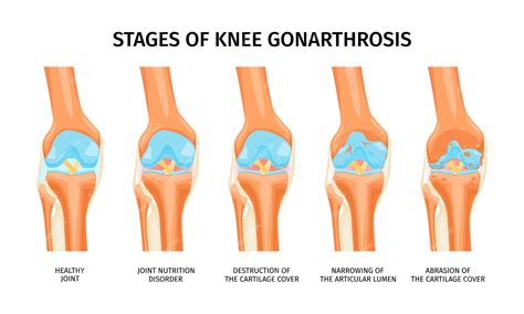 Premium Vector | Realistic infographics presenting stages of knee gonarthrosis from healthy ...