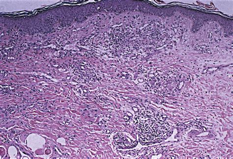 Successful Treatment of Granulomatous Cheilitis With Thalidomide ...