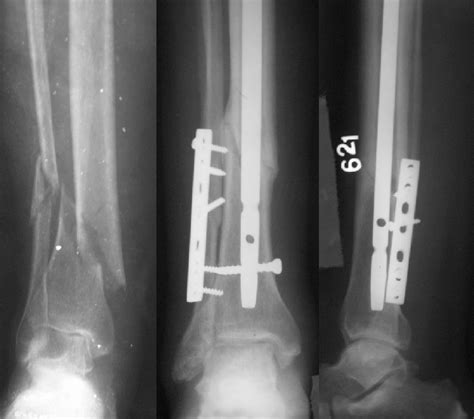 Im Nailing Tibia Procedure - Nail Ftempo