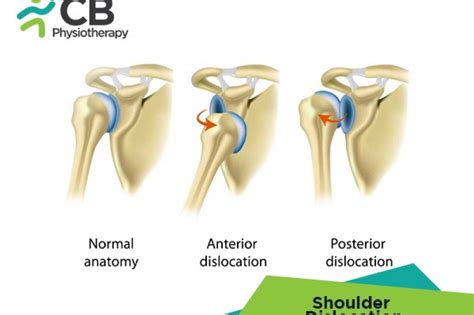 Shoulder Dislocation