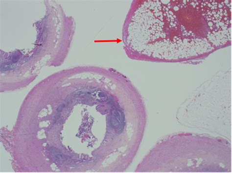 Cureus | Epiploic Appendagitis Masquerading as Acute Appendicitis: A Report of Two Cases