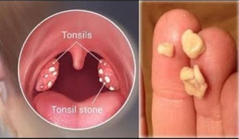 How to get rid of Swollen Tonsils Fast in 24 hours - Right Home Remedies