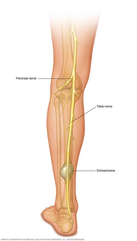 SCHWANNOMA - Cirugia de Columna en Matamoros