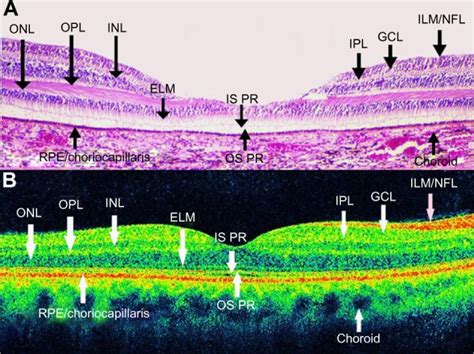 OCT shows a normal eye. Notes: It has been considered that OCT allows... | Download Scientific ...