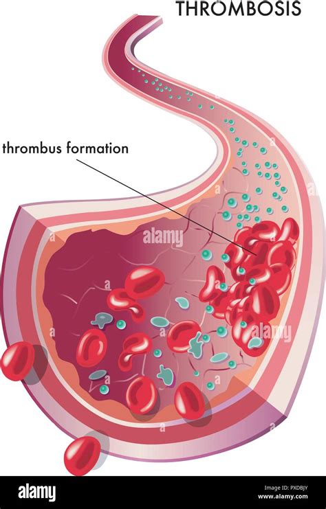 Thrombus hi-res stock photography and images - Alamy