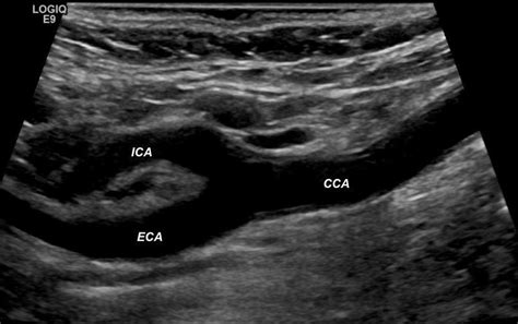 Doppler Extra-Cranial Carotid Assessment, Protocols, and Interpretation - StatPearls - NCBI ...