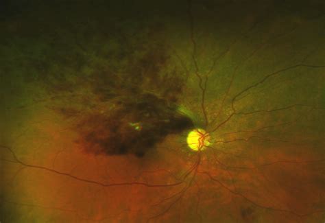 Branch Retinal Vein Occlusion with Cystoid Macular Edema - EyeCarePD