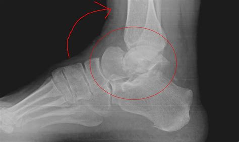 Dr. K. Lam Straight Talk: Talus fracture : Personal Injuries #PI common in motor vehicle ...