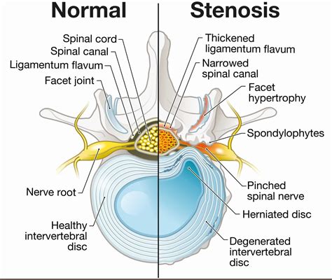 Central Canal Stenosis: Definition - Spine Info