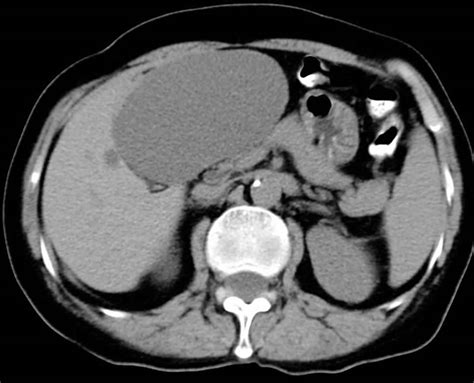 Liver cyst causes, symptoms, diagnosis & treatment