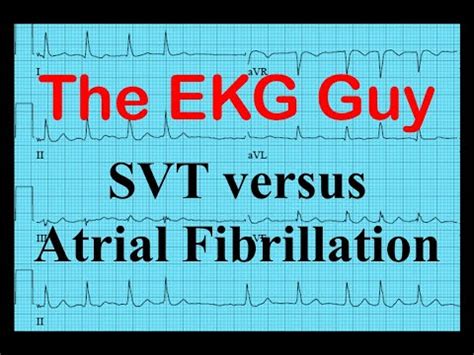 الفرق بين AFIB و VFIB و SVT | قارن الفرق بين المصطلحات المتشابهة - الحياة - 2023