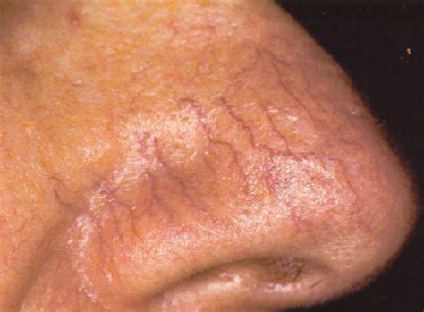 Telangiectasia - Pictures, Symptoms, Causes, Treatment | HubPages