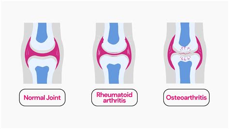 Is Arthritis Genetic?