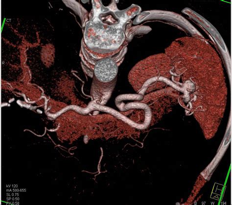 3D Rendering of a Splenic Artery Aneurysm - Spleen Case Studies - CTisus CT Scanning