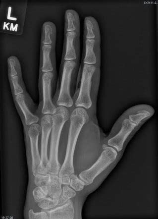 Normal oblique hand radiograph | Radiology Case | Radiopaedia.org