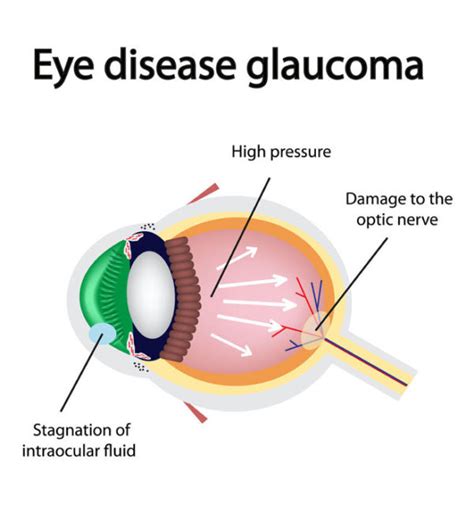 Auckland Eye Care | Optometrist Auckland | Glaucoma & cataract checks