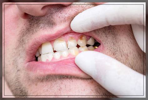 Enamel Hypoplasia: Causes, Symptoms, and Treatments - Dentist Ahmed