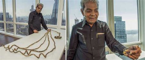 Shridhar Chillal's hand permanently handicapped for not cutting nails for 66 years