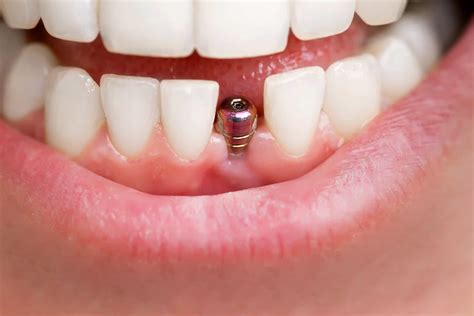 Anterior Implant Rehabilitation: Setting the Foundation Page 1 of 0 - Burbank Dental Lab