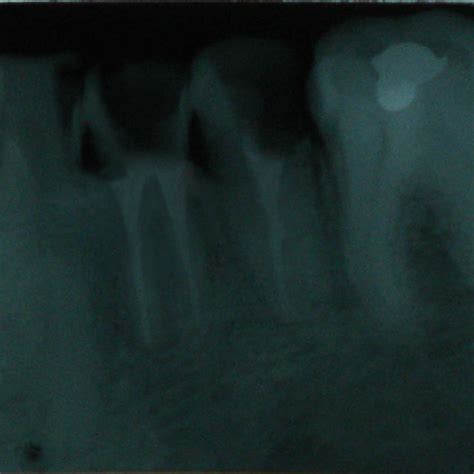 Pre-operative Intraoral periapical radiograph | Download Scientific Diagram