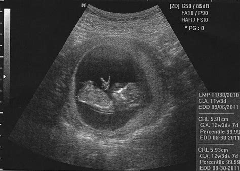 Baby Ultrasound Funny Quotes. QuotesGram