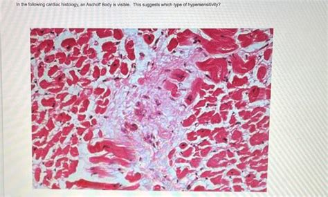 Solved In the following cardiac histology, an Aschoff Body | Chegg.com