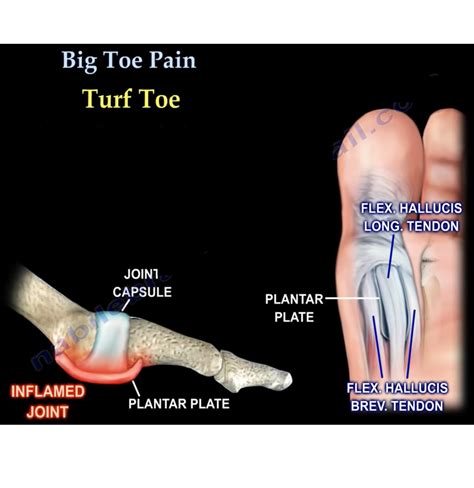 Great toe Pain — OrthopaedicPrinciples.com