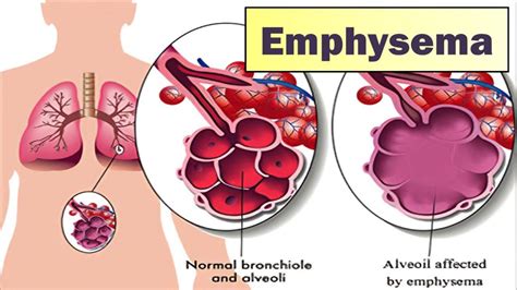 Emphysema - Symptoms And Causes | POSTEEZY