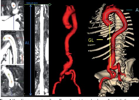 Figure 1 from Increased aortic tortuosity indicates a more severe aortic phenotype in adults ...